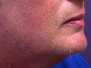 Hirsutism Dermnet Nz